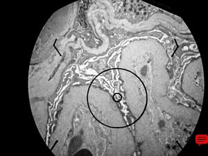 M,69y. | advanced diabetic glomerulosclerosis- thickened basement membranes,fused pedicles